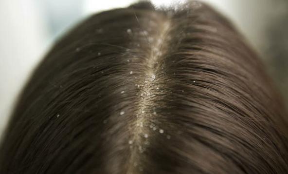 خواص بارهنگ برای از بین بردن شوره سر